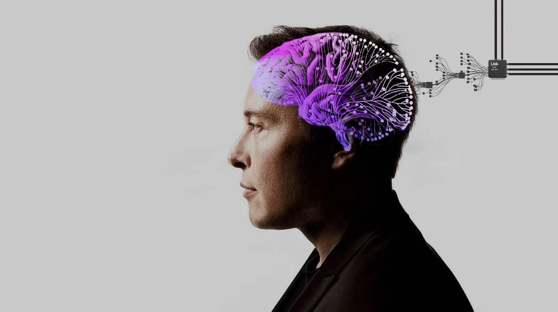 Neuralink успешно вживила имплант в мозг своего второго пациента